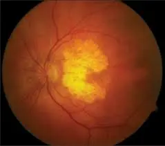 Can zeaxanthin reverse macular degeneration