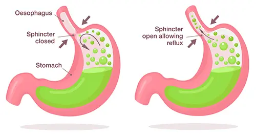 How does omeprazole work to treat acid reflux